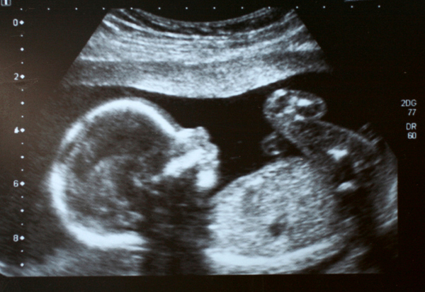 Le 3 ecografie che si possono fare in gravidanza: bidimesionale, 3D e 4D