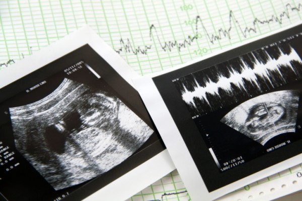 Aborti in calo, per la prima volta sotto la soglia dei 100.000 annui
