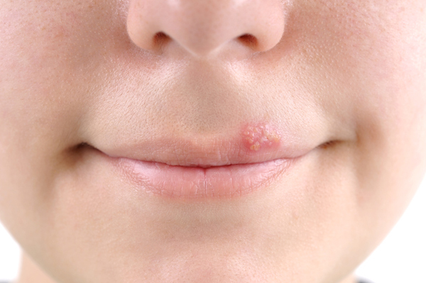 Omeopatia contro l'herpes labiale